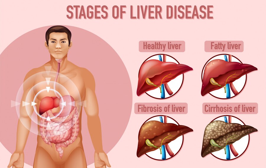 Acute Liver Failure