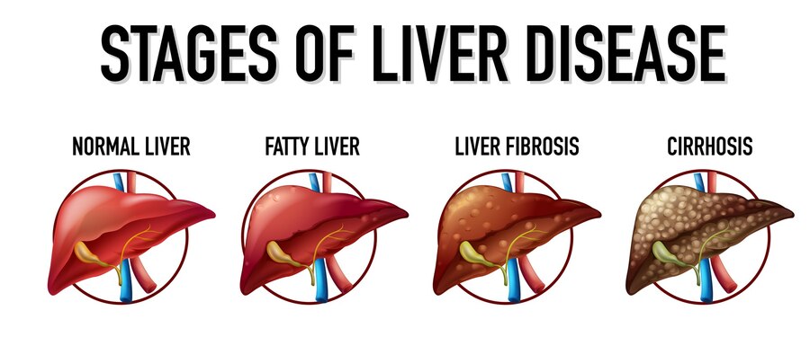 Chronic Liver Disease